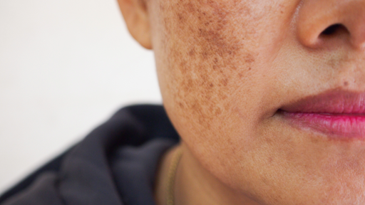 advanced Melasma skincare treatment